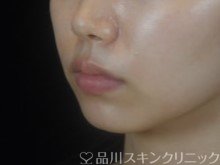 症例NO.74377のBEFORE写真