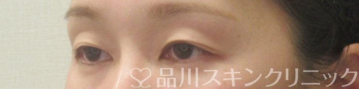 症例NO.75160のBEFORE写真