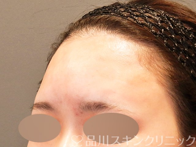 症例NO.70115のAFTER写真