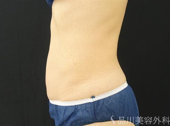 症例NO.44767のAFTER写真