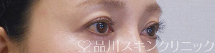 症例NO.71091のAFTER写真