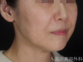 症例NO.73524のBEFORE写真