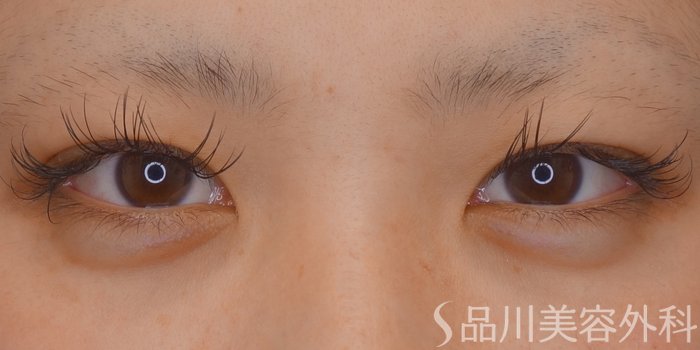症例NO.69308のBEFORE写真