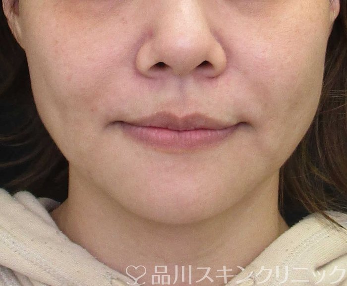 症例NO.65388のBEFORE写真