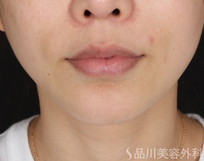 症例NO.71444のBEFORE写真