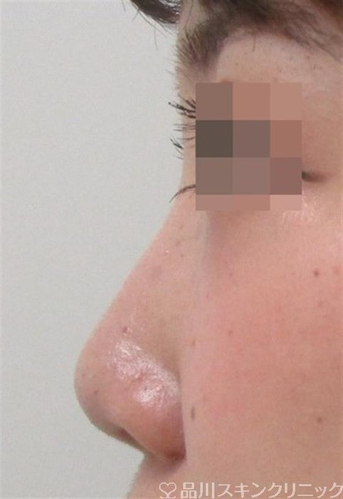 症例NO.29161のAFTER写真