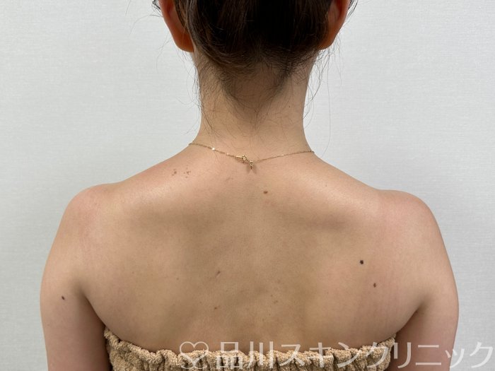 症例NO.74883のAFTER写真