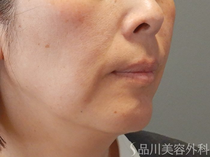 症例NO.70288のBEFORE写真