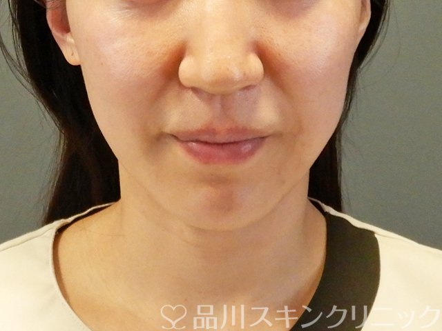 症例NO.63831のBEFORE写真