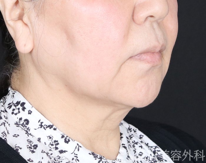 症例NO.73691のBEFORE写真