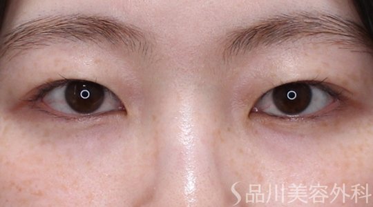 症例NO.74368のBEFORE写真
