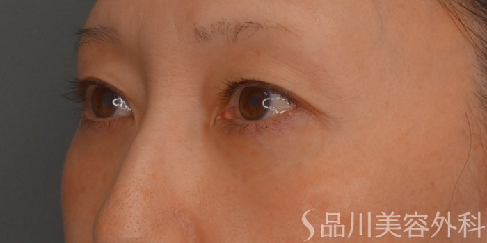 症例NO.75112のBEFORE写真