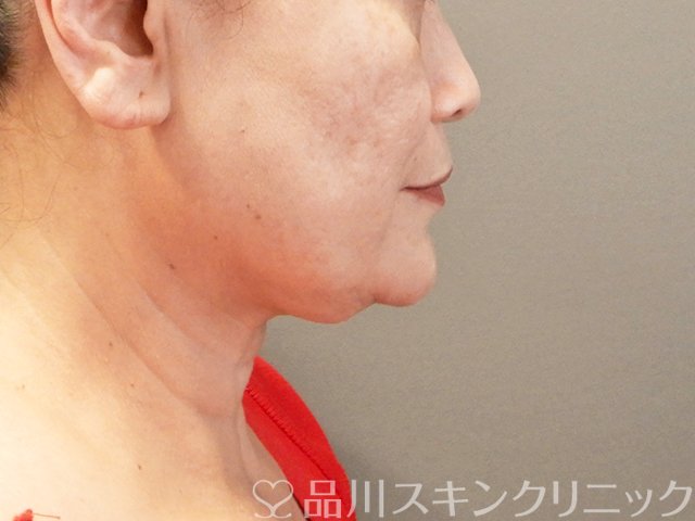 症例NO.66542のAFTER写真
