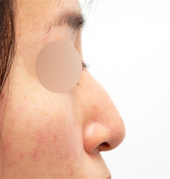 症例NO.53150のBEFORE写真