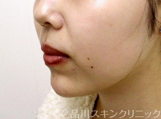 症例NO.65155のAFTER写真