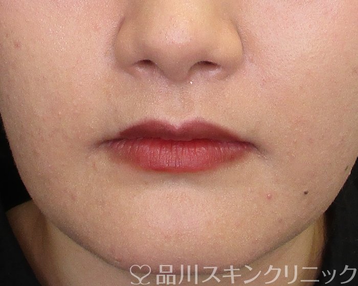 症例NO.74148のBEFORE写真