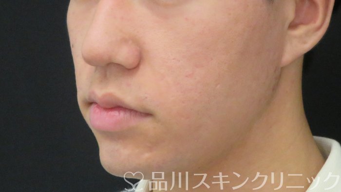 症例NO.71852のBEFORE写真