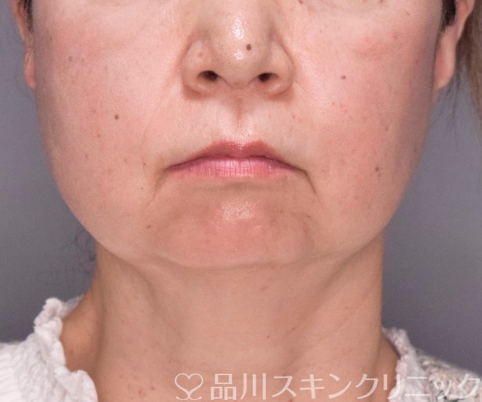 症例NO.69420のBEFORE写真
