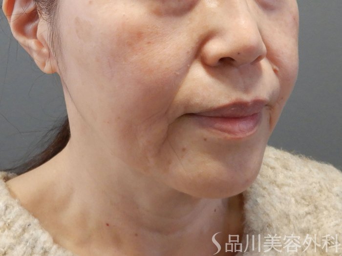 症例NO.70991のBEFORE写真