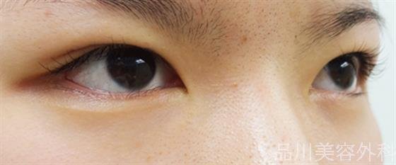 症例NO.33250のBEFORE写真