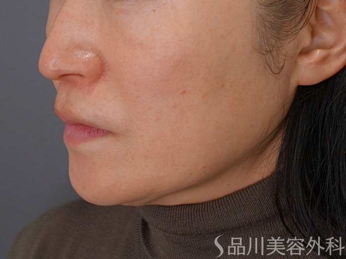 症例NO.74759のBEFORE写真