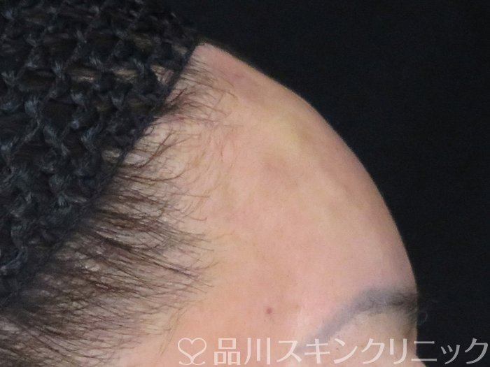 症例NO.69512のAFTER写真