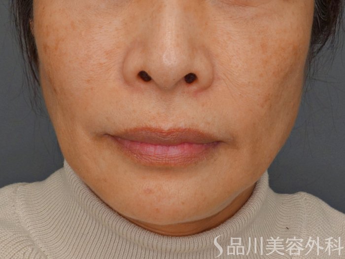 症例NO.73431のBEFORE写真