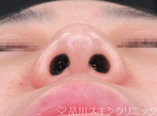症例NO.69945のBEFORE写真