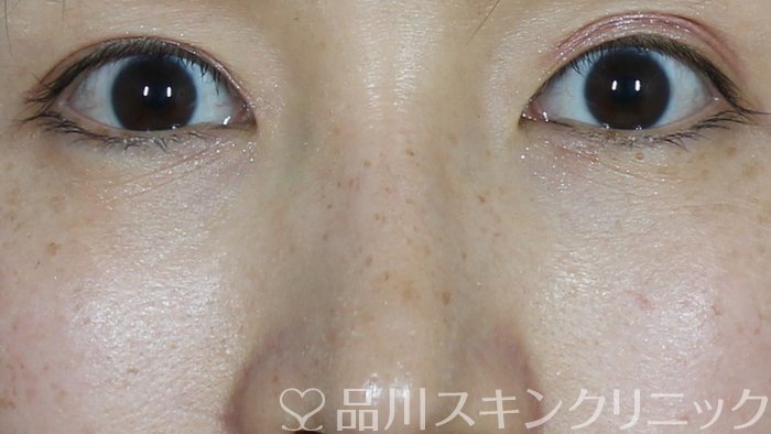 症例NO.71452のAFTER写真