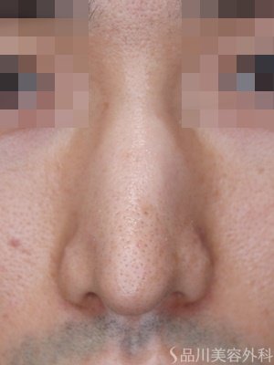 症例NO.65506のAFTER写真