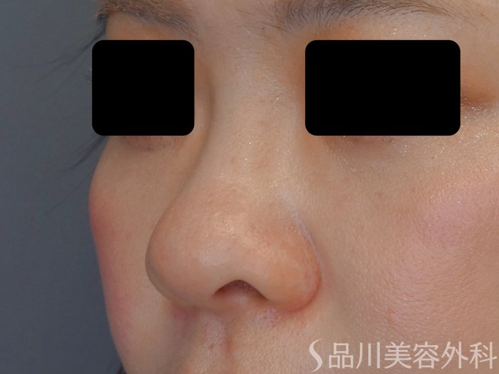 症例NO.67755のBEFORE写真