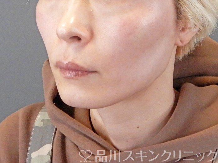 症例NO.63541のAFTER写真