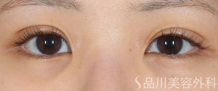 症例NO.72830のAFTER写真