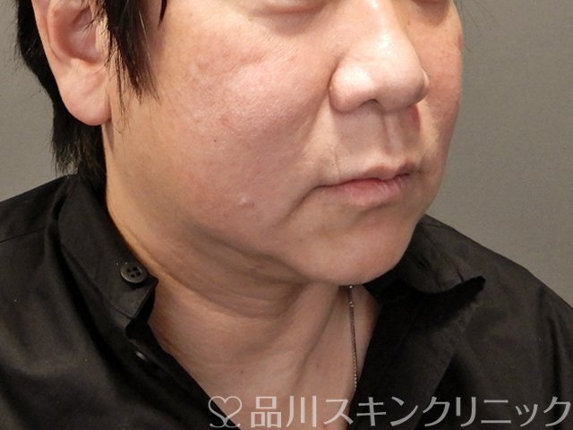 症例NO.68572のAFTER写真