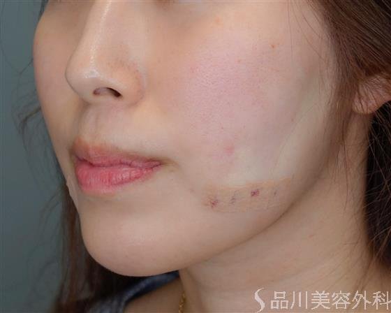 症例NO.50855のAFTER写真
