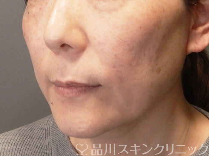 症例NO.70301のBEFORE写真