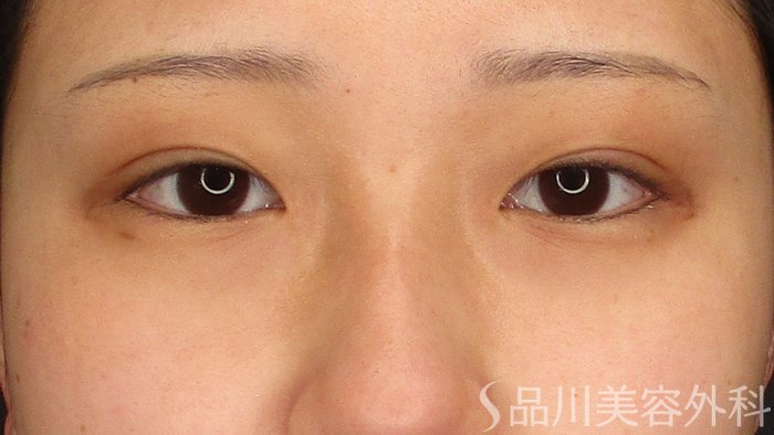 症例NO.69412のAFTER写真