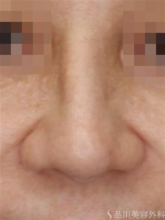 症例NO.53237のBEFORE写真