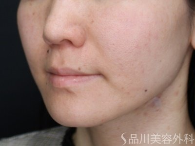 症例NO.70792のBEFORE写真