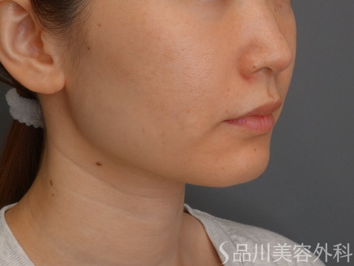 症例NO.75102のBEFORE写真