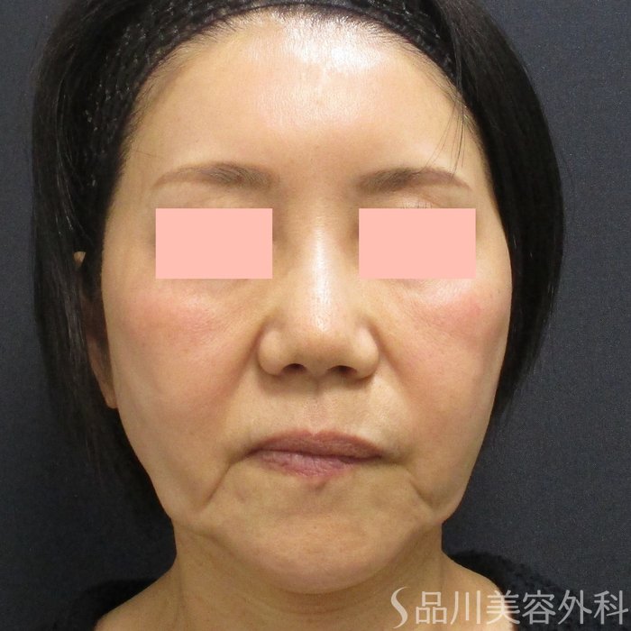 症例NO.73505のBEFORE写真