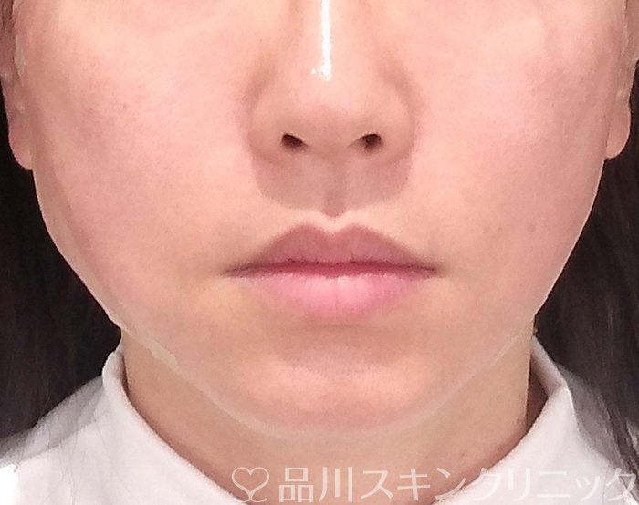 症例NO.69488のAFTER写真