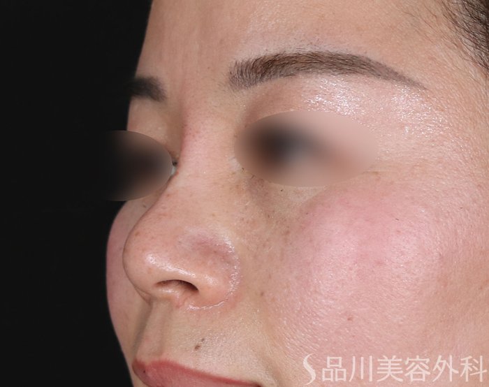 症例NO.73104のAFTER写真