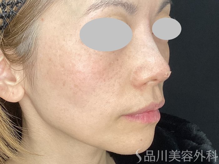 症例NO.72541のAFTER写真