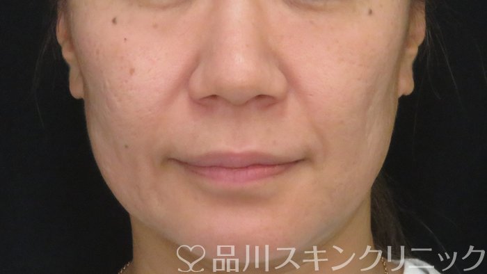 症例NO.71121のBEFORE写真