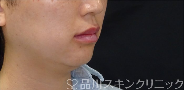 症例NO.72063のAFTER写真