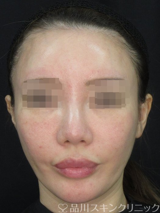 症例NO.72527のAFTER写真