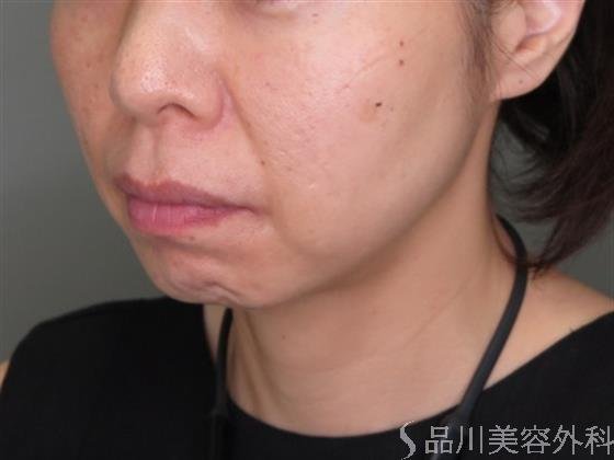 症例NO.48038のBEFORE写真