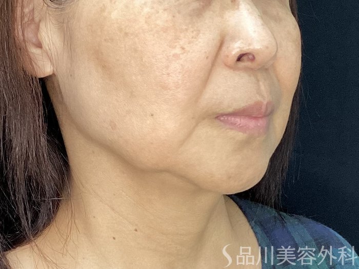 症例NO.71984のBEFORE写真