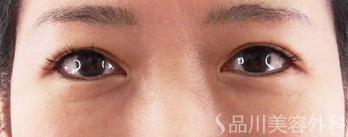 症例NO.67862のBEFORE写真